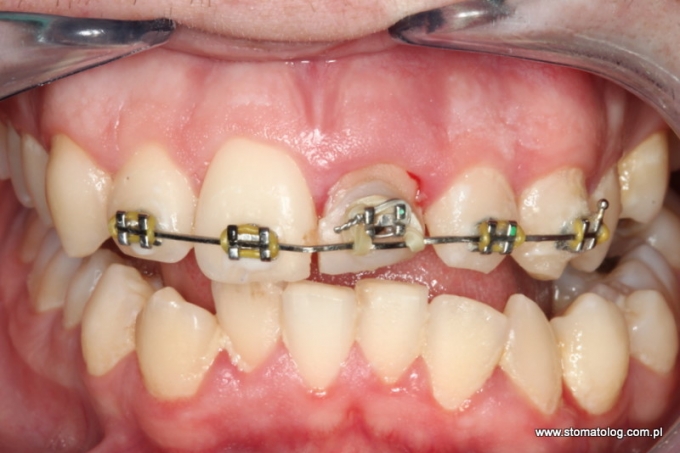 ekstruzja ortodontyczna