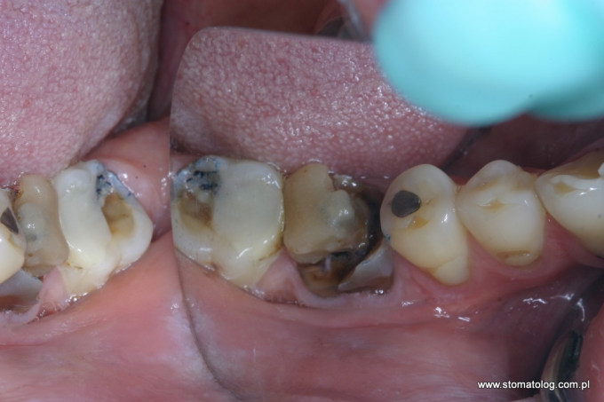 rekonstrukcja zęba iława