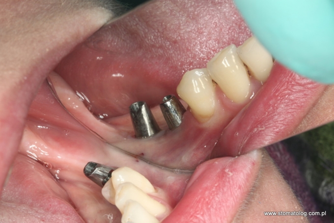 implanty stomatologiczne