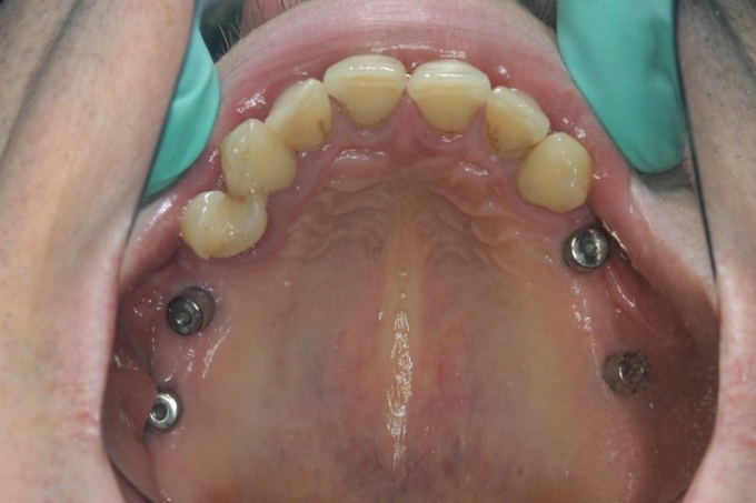 odbudowa zębów na implantach