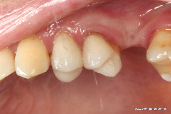 leczenie kanałowe oraz odbudowa zęba