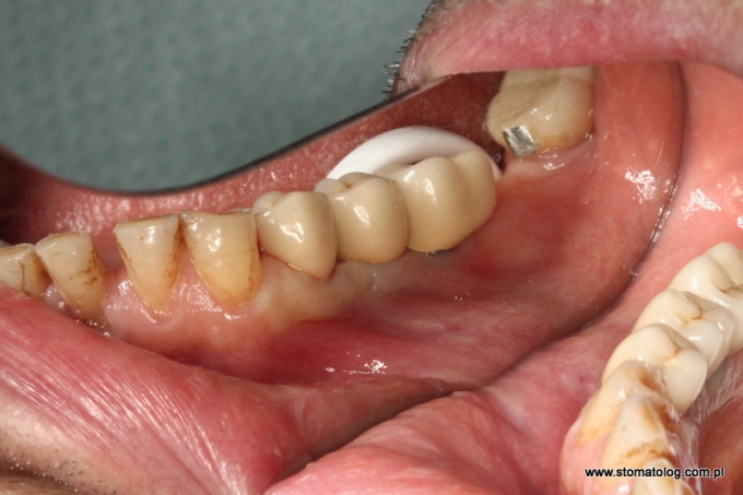 odtworzenie zębów za pomocą implantów