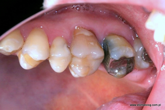 odtworzenie zębów na implantach