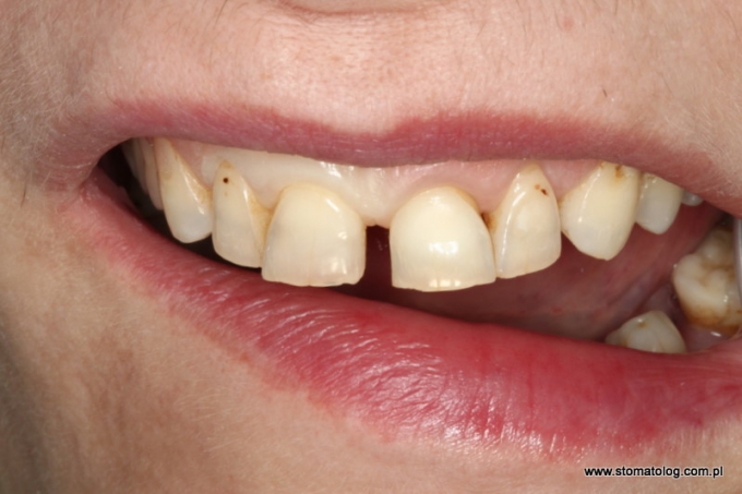 Lic wki Kosmetyczne Implanty Z b w Stomatologia Estetyczna