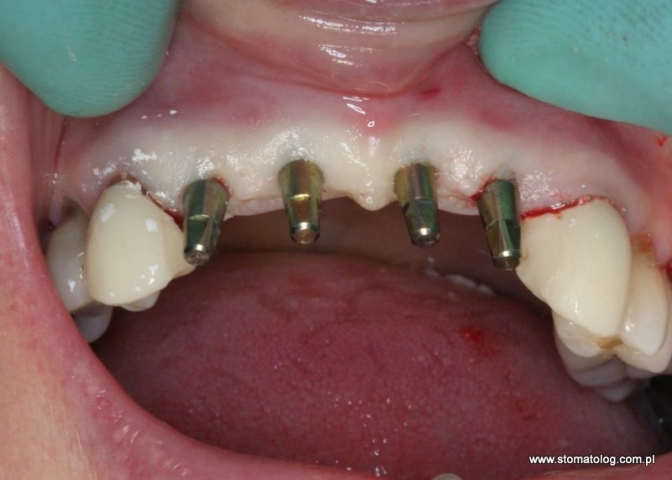 rekonstrukcje zębów