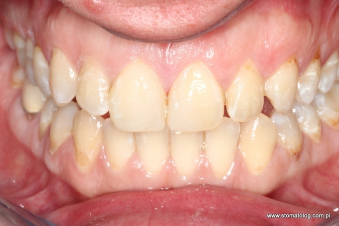 korekta kształtu zębów