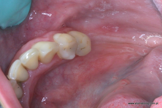 implanty stomatologiczne iława