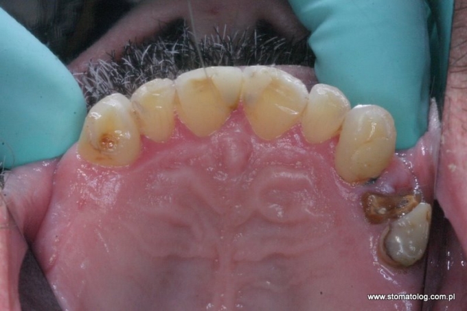 odbudowa zębów na implantach