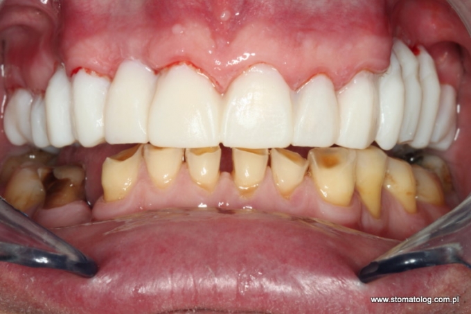 odbudowa zębów u bruksisty