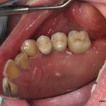 implanty dentystyczne