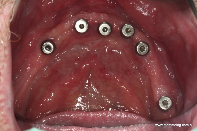 implanty zębów iława