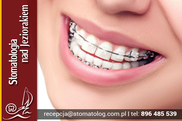 aparaty samoligaturujące